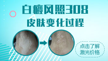 成年白癜风早期症状